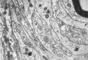 F,12y. | hypertrophic (onion bulb) neuropathy - n.suralis